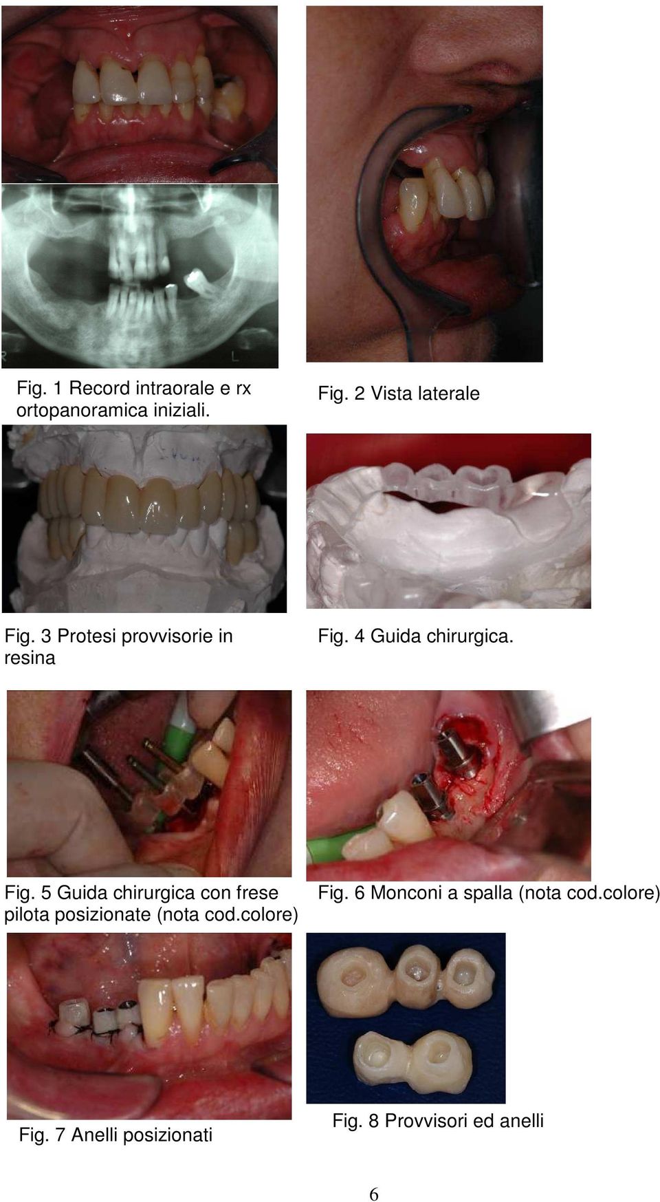 Fig. 5 Guida chirurgica con frese pilota posizionate (nota cod.colore) Fig.