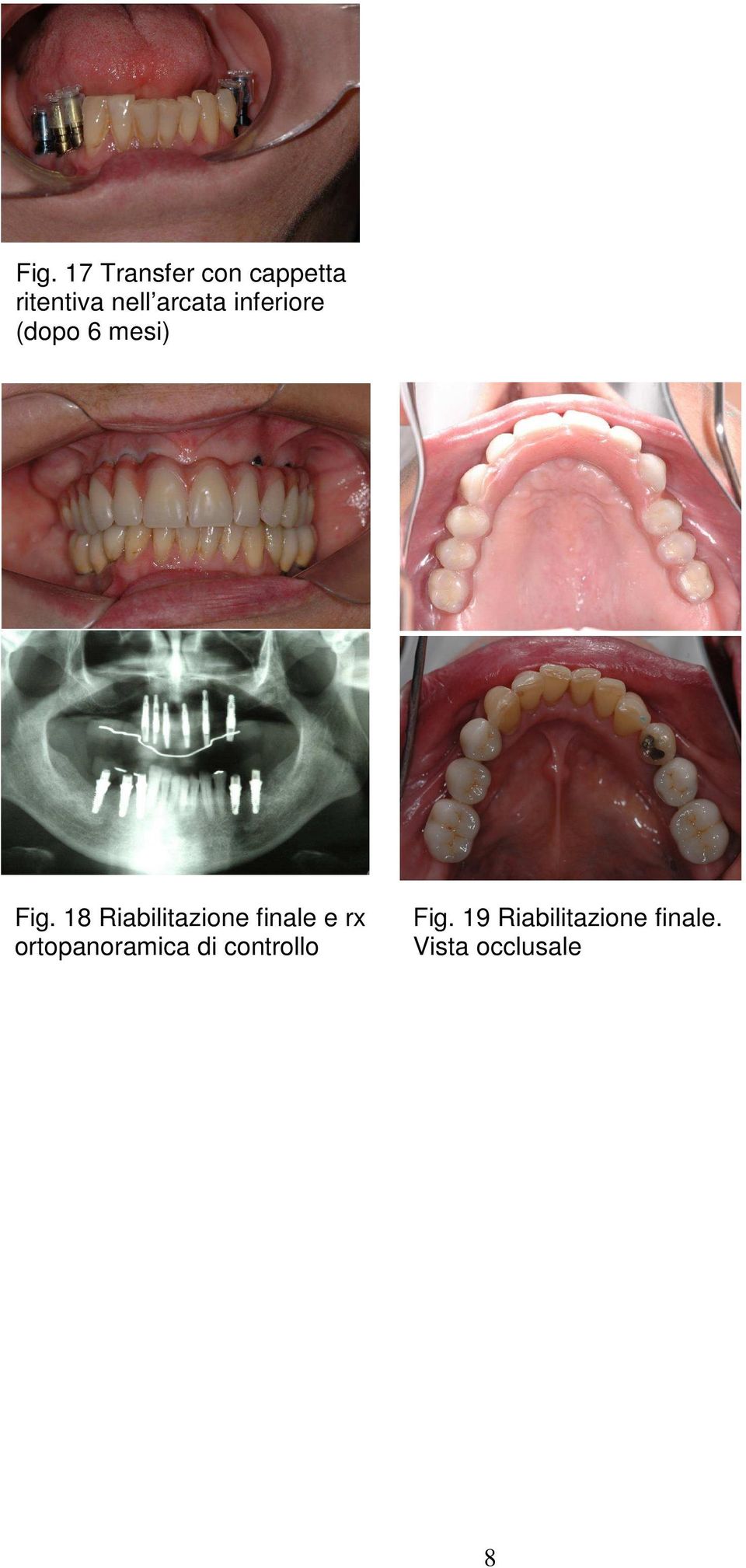 18 Riabilitazione finale e rx ortopanoramica