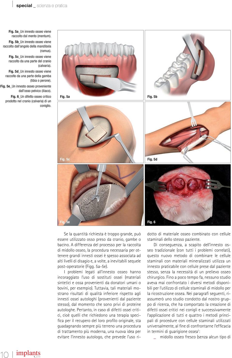 Fig. 5a Fig. 5b Fig. 5c Fig. 5d Fig. 5e Fig. 6 Se la quantità richiesta è troppo grande, può essere utilizzato osso preso da cranio, gambe o bacino.