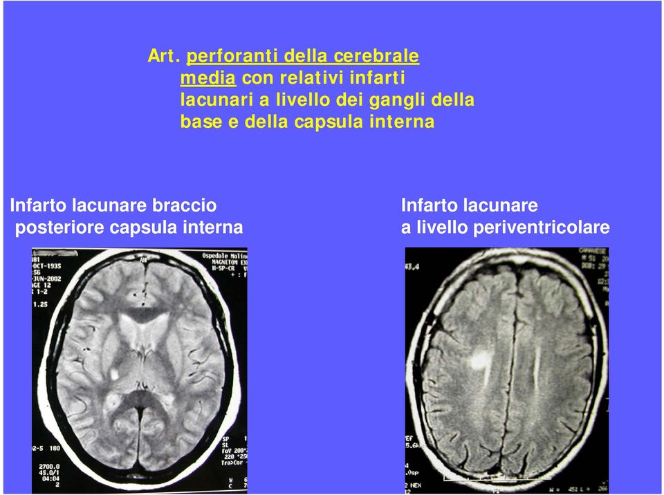 della capsula interna Infarto lacunare braccio