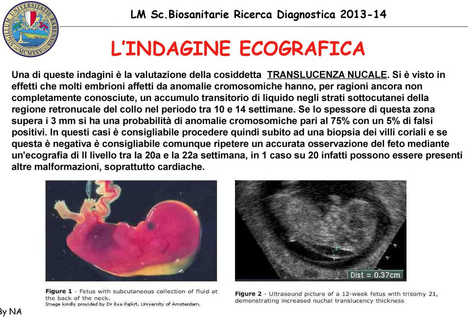 regione retronucale del collo nel periodo tra 10 e 14 settimane. Se lo spessore di questa zona supera i 3 mm si ha una probabilità di anomalie cromosomiche pari al 75% con un 5% di falsi positivi.