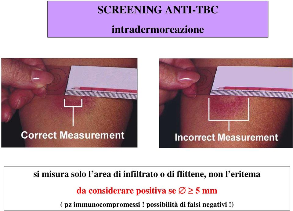 eritema da considerare positiva se 5 mm ( pz