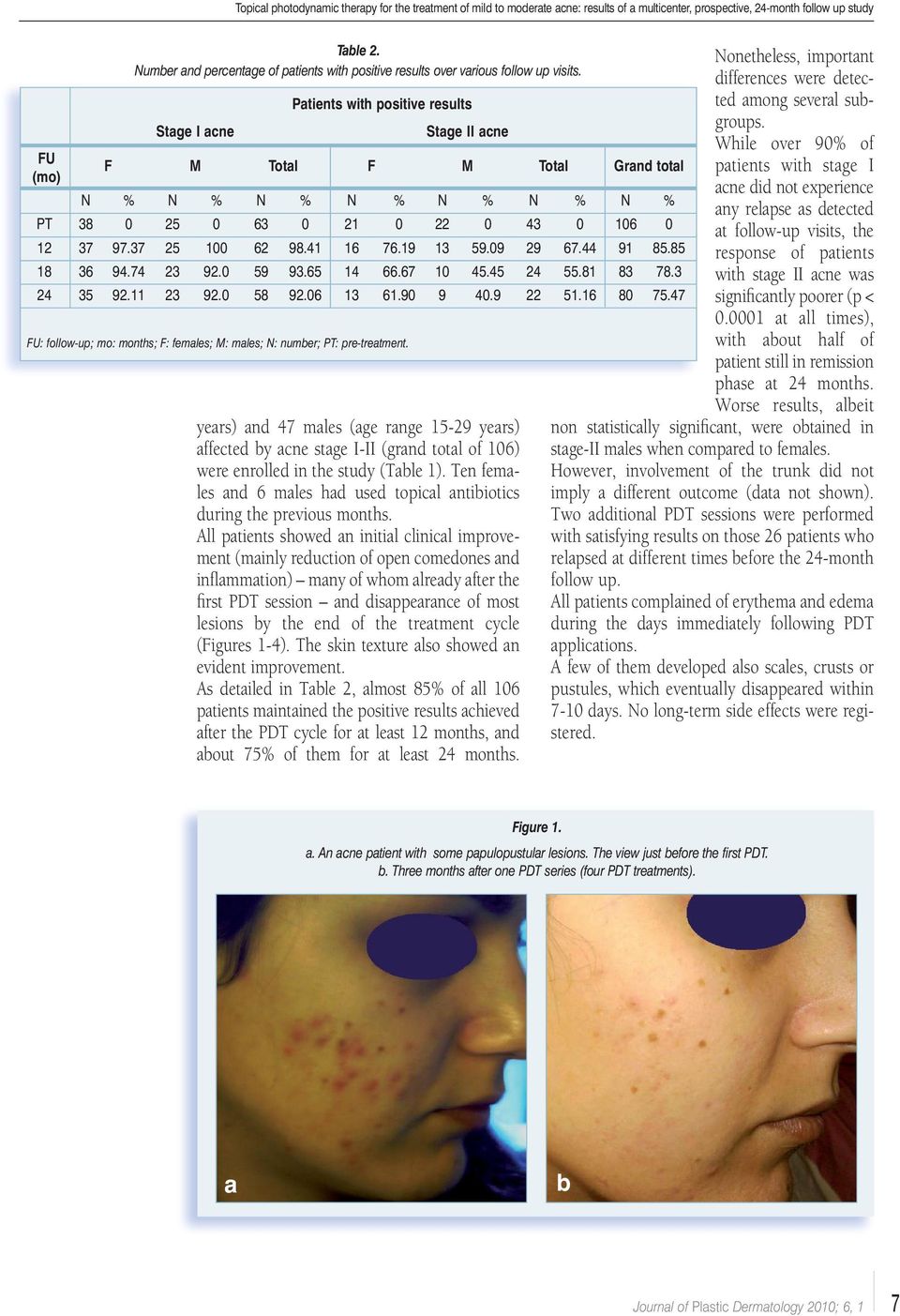 Stage I acne Patients with positive results Stage II acne F M Total F M Total Grand total N % N % N % N % N % N % N % PT 38 0 25 0 63 0 21 0 22 0 43 0 106 0 12 37 97.37 25 100 62 98.41 16 76.19 13 59.