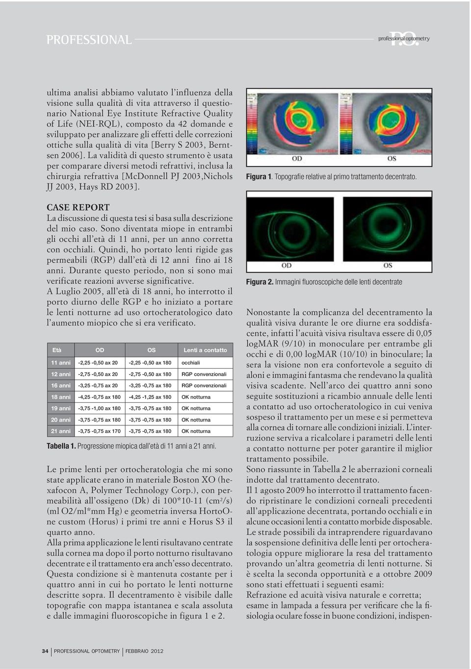 Nell arco dei quattro anni sono seguite sostituzioni a ricambio annuale delle lenti a contatto ad uso ortocheratologico in cui veniva sospeso il trattamento per un mese e si permetteva alla cornea di