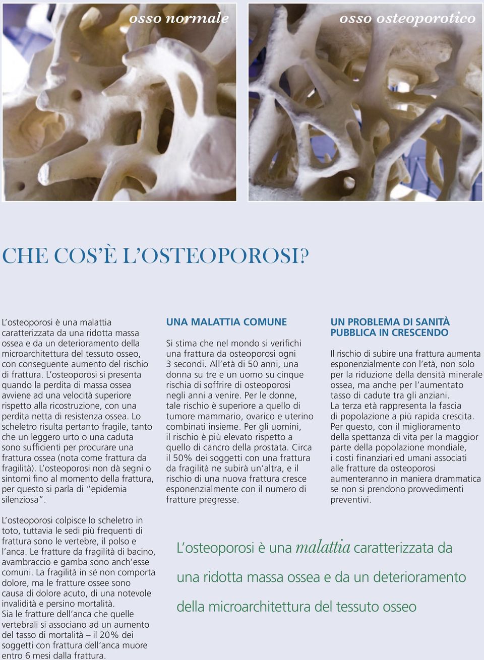 L osteoporosi si presenta quando la perdita di massa ossea avviene ad una velocità superiore rispetto alla ricostruzione, con una perdita netta di resistenza ossea.