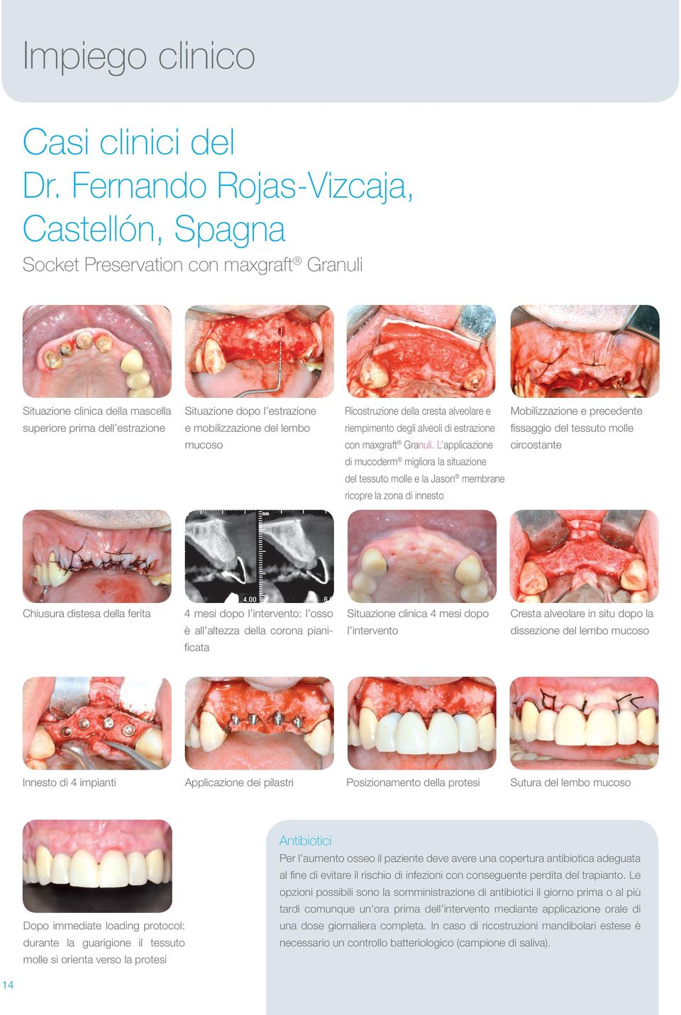 e precedente superiore prima dell estrazione e mobilizzazione del lembo riempimento degli alveoli di estrazione fissaggio del tessuto molle mucoso con maxgraft Granuli.