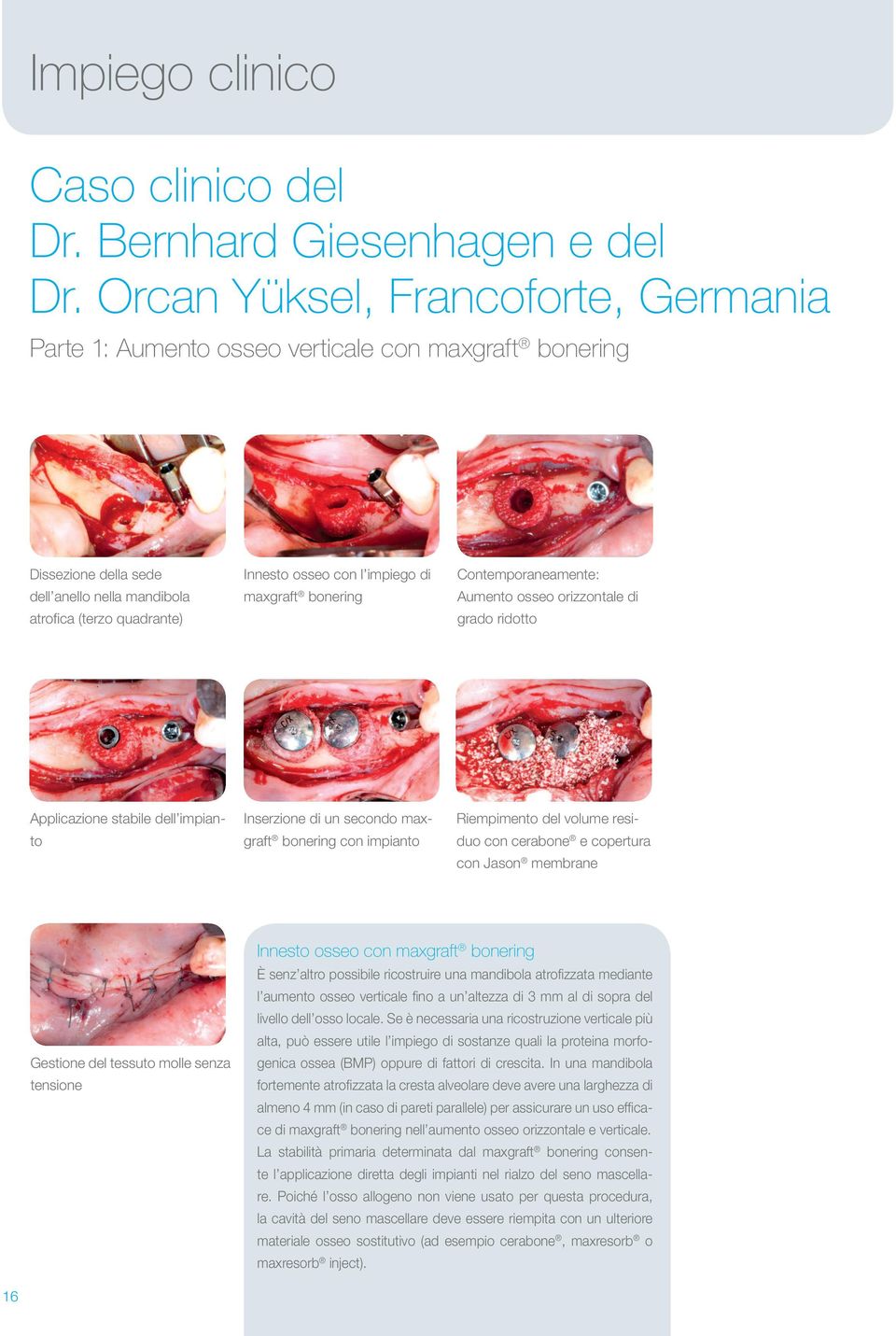 maxgraft bonering Contemporaneamente: Aumento osseo orizzontale di grado ridotto Applicazione stabile dell impianto Inserzione di un secondo maxgraft bonering con impianto Riempimento del volume