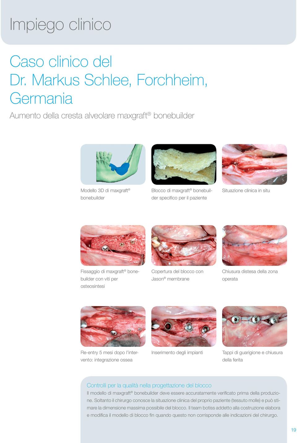 in situ Fissaggio di maxgraft bonebuilder con viti per osteosintesi Copertura del blocco con Jason membrane Chiusura distesa della zona operata Re-entry 5 mesi dopo l intervento: integrazione ossea