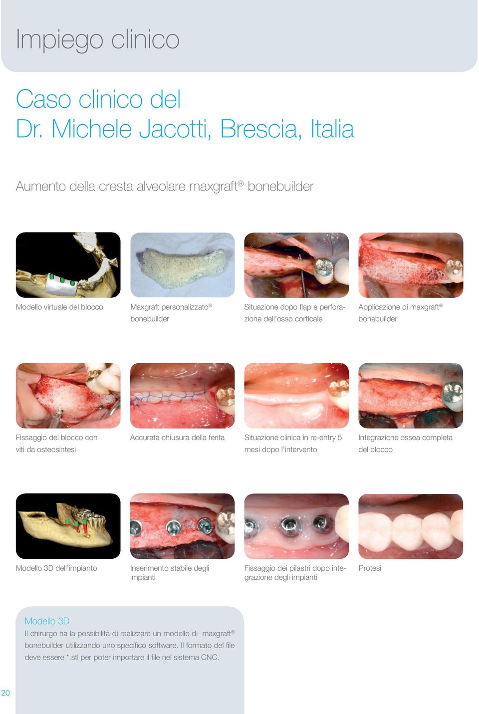 corticale Applicazione di maxgraft bonebuilder Fissaggio del blocco con Accurata chiusura della ferita Situazione clinica in re-entry 5 Integrazione ossea completa viti da osteosintesi mesi dopo l