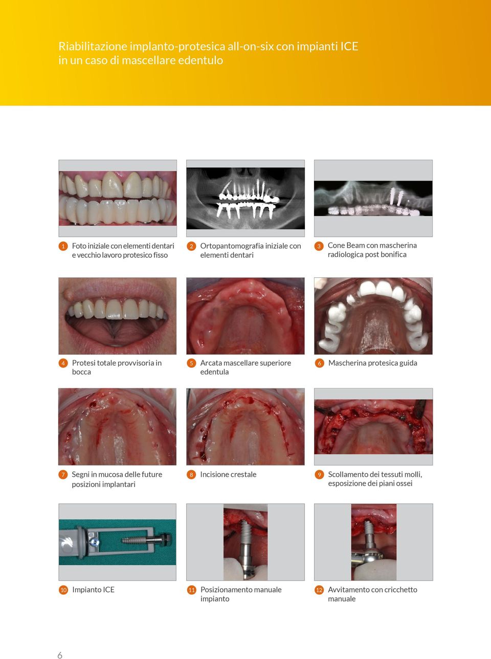 in bocca 5 Arcata mascellare superiore edentula 6 Mascherina protesica guida 7 Segni in mucosa delle future posizioni implantari 8 Incisione crestale