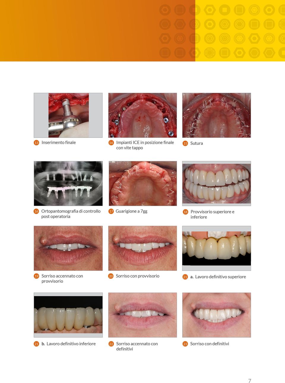 inferiore 19 Sorriso accennato con provvisorio 20 Sorriso con provvisorio 21 a.