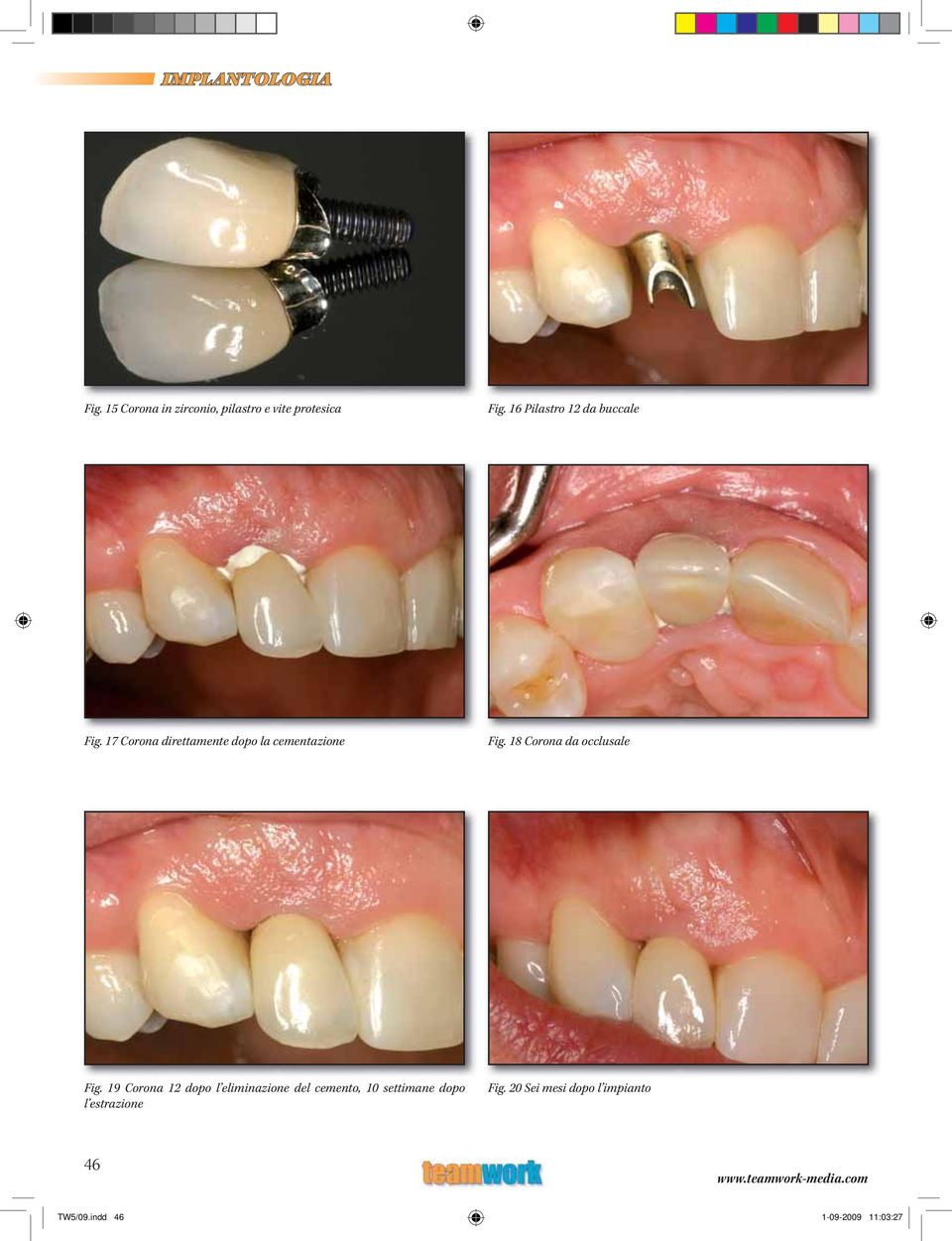 18 Corona da occlusale Fig.