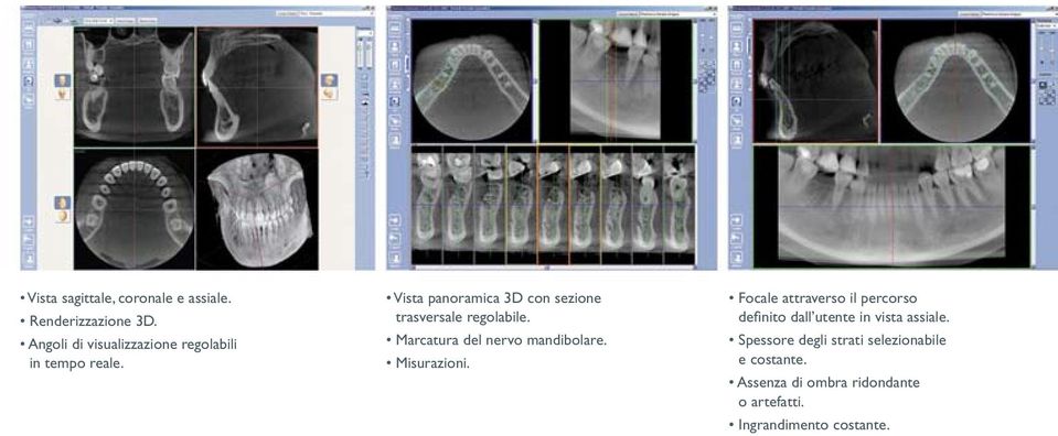 Vista panoramica 3D con sezione trasversale regolabile. Marcatura del nervo mandibolare.