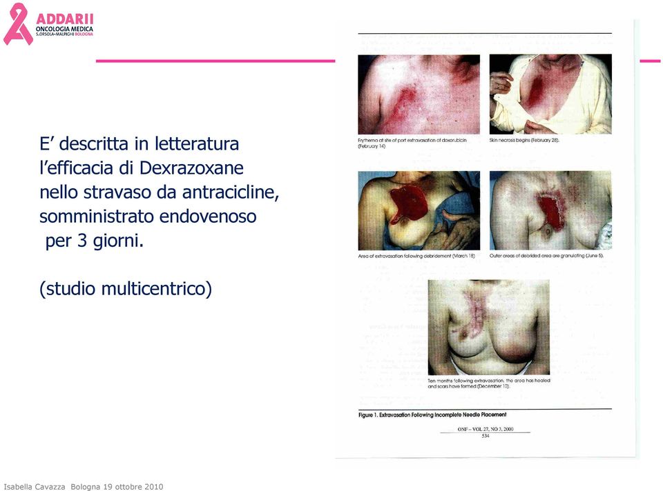 stravaso da antracicline,