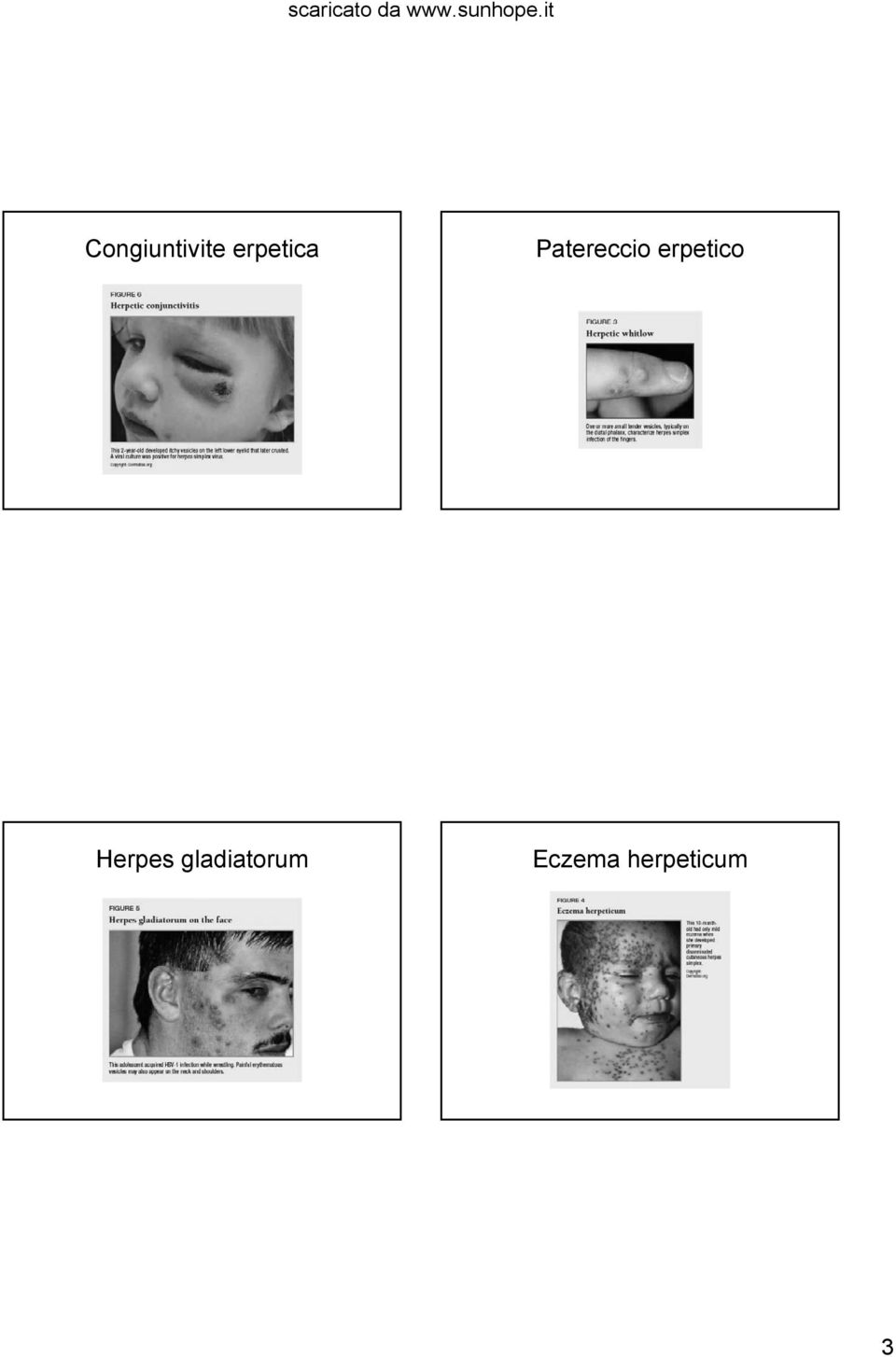 erpetico Herpes