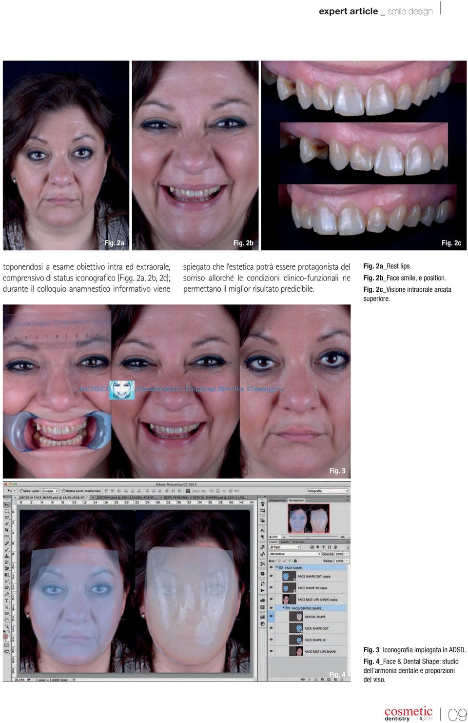 condizioni clinico-funzionali ne permettano il miglior risultato predicibile. Fig. 2a_Rest lips. Fig. 2b_Face smile, e position. Fig. 2c_Visione intraorale arcata superiore.