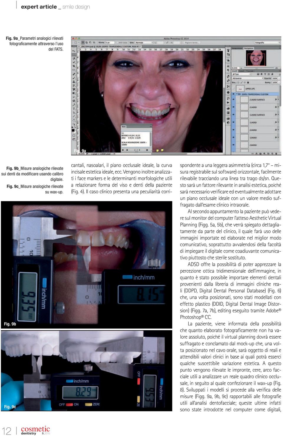 Vengono inoltre analizzati i face markers e le determinanti morfologiche utili a relazionare forma del viso e denti della paziente (Fig. 4).