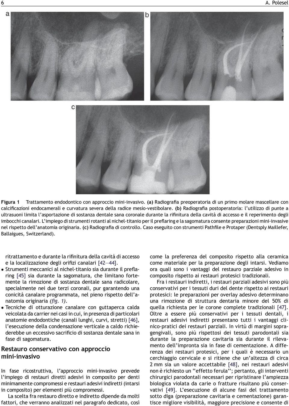 (b) Radiografia postoperatoria: l utilizzo di punte a ultrasuoni limita l asportazione di sostanza dentale sana coronale durante la rifinitura della cavità di accesso e il reperimento degli imbocchi