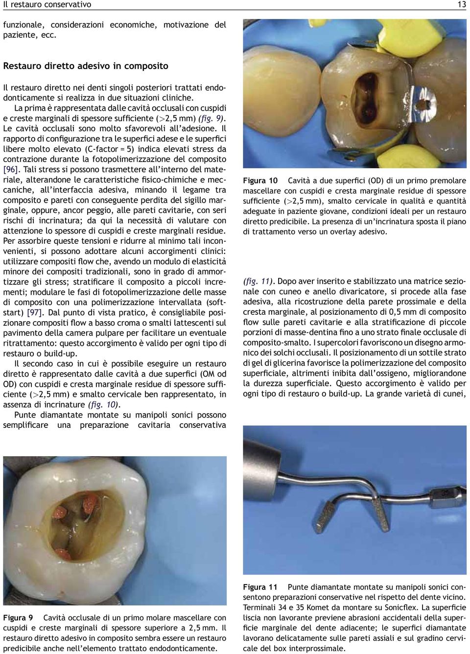 La prima è rappresentata dalle cavità occlusali con cuspidi e creste marginali di spessore sufficiente (>2,5 mm) (fig. 9). Le cavità occlusali sono molto sfavorevoli all adesione.