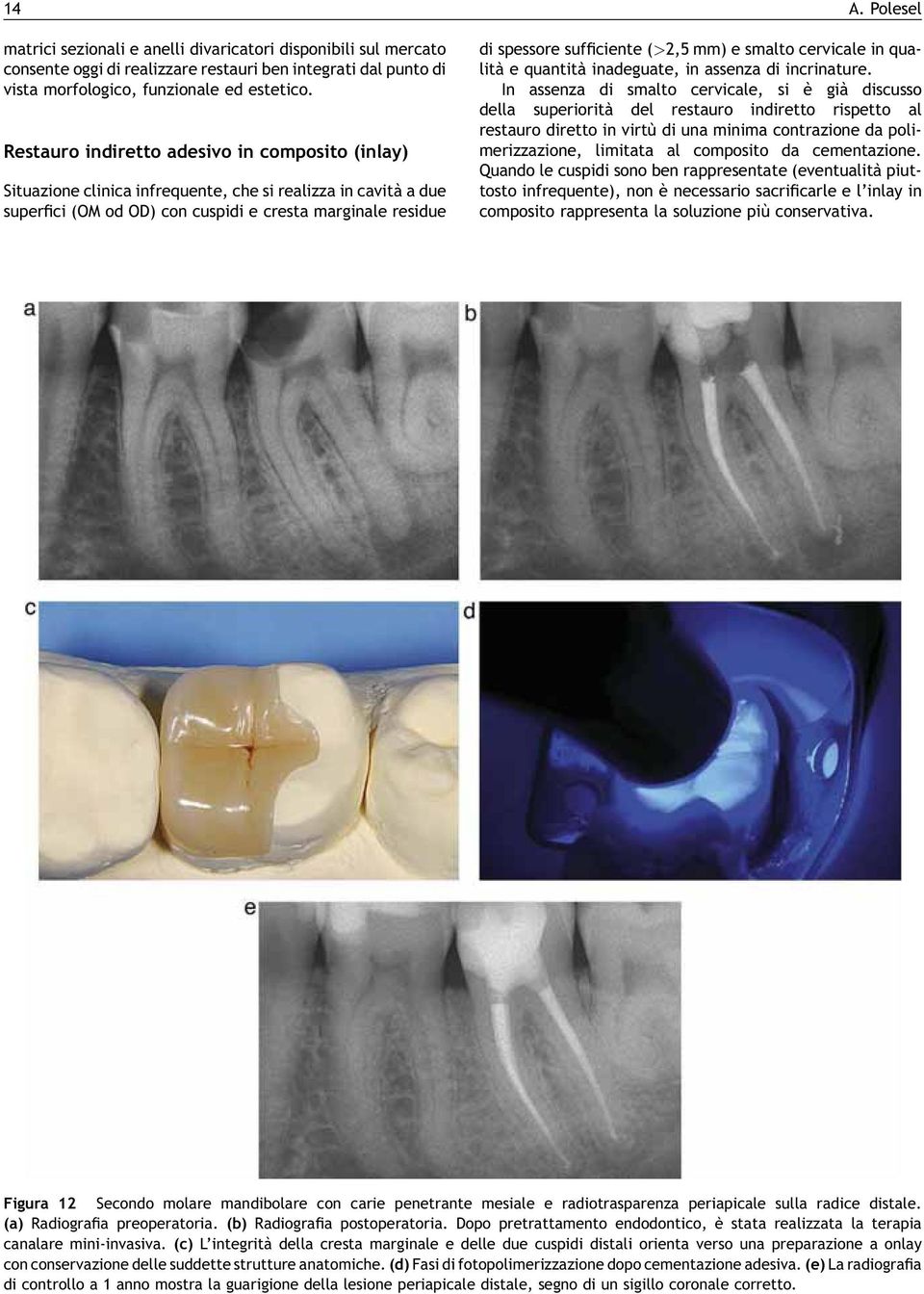 (>2,5 mm) e smalto cervicale in qualità e quantità inadeguate, in assenza di incrinature.