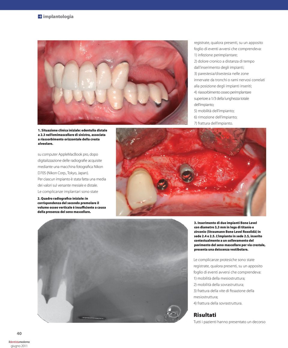 dell impianto; 5) mobilità dell impianto; 6) rimozione dell impianto; 7) frattura dell impianto. 1. Situazione clinica iniziale: edentulia distale a 2.