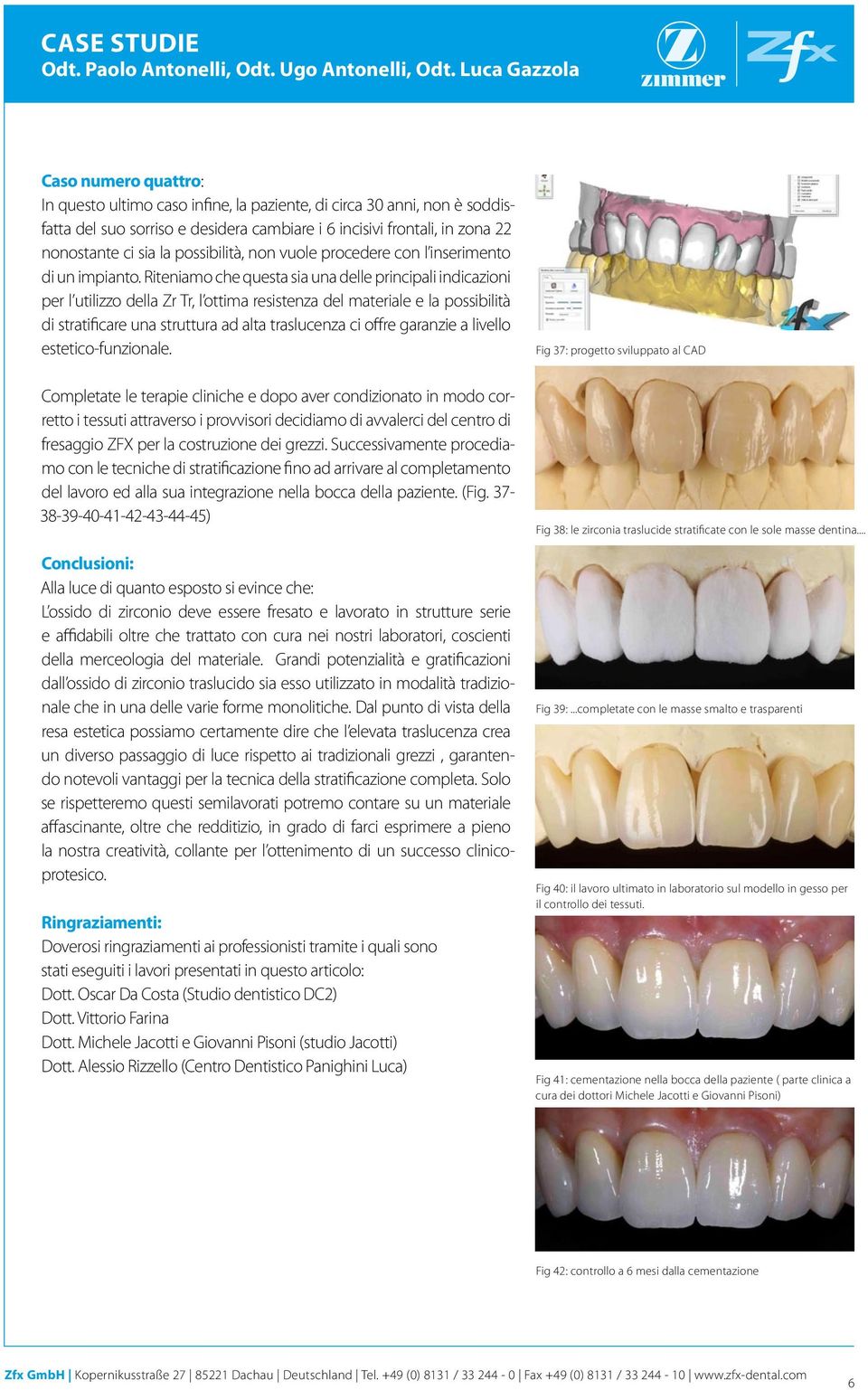 Riteniamo che questa sia una delle principali indicazioni per l utilizzo della Zr Tr, l ottima resistenza del materiale e la possibilità di stratificare una struttura ad alta traslucenza ci offre