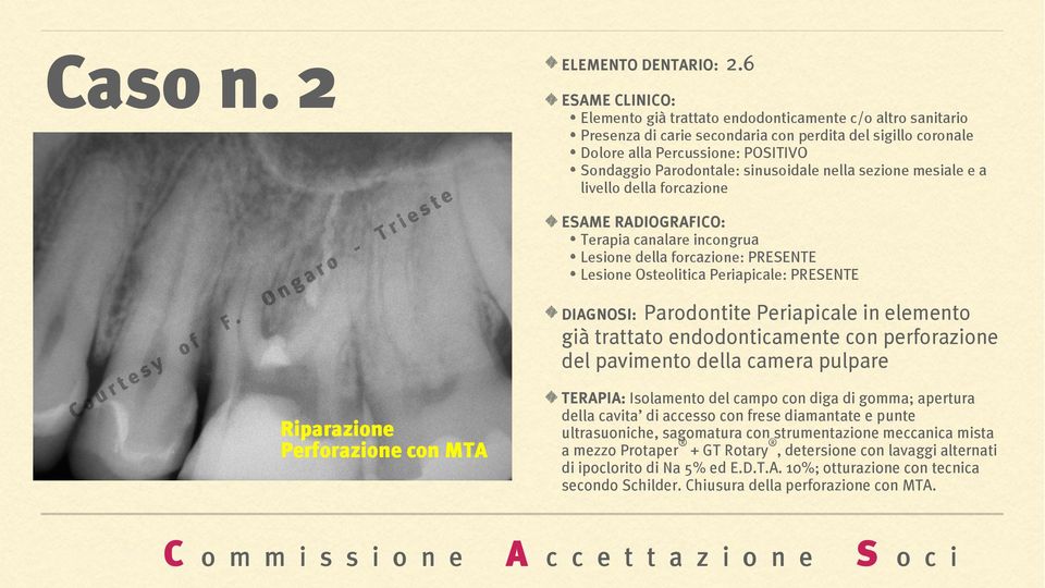 sezione mesiale e a livello della forcazione Terapia canalare incongrua Lesione della forcazione: PRESENTE Lesione Osteolitica Periapicale: PRESENTE DIAGNOSI: Parodontite Periapicale in elemento già