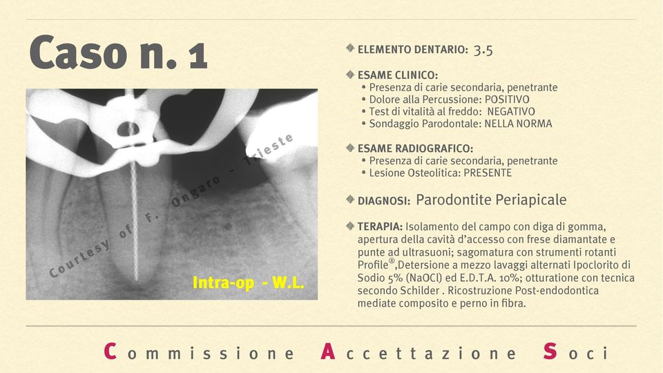 secondaria, penetrante Lesione Osteolitica: PRESENTE DIAGNOSI: Parodontite Periapicale TERAPIA: Isolamento del campo con diga di gomma, apertura della cavità d accesso con