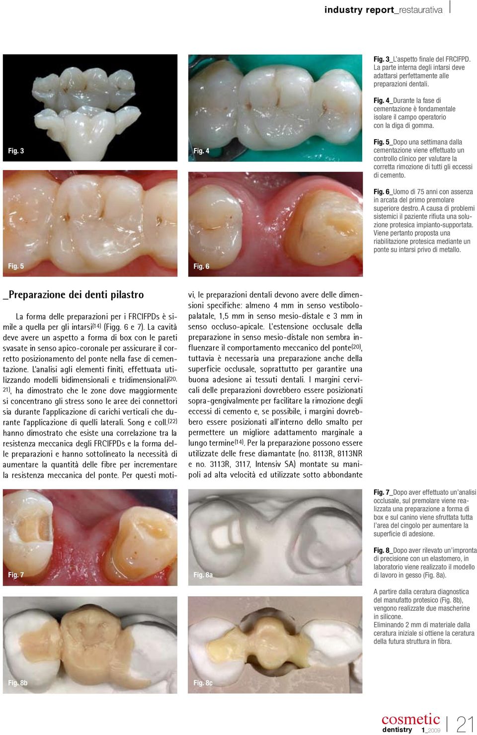 5_Dopo una settimana dalla cementazione viene effettuato un controllo clinico per valutare la corretta rimozione di tutti gli eccessi di cemento. Fig.