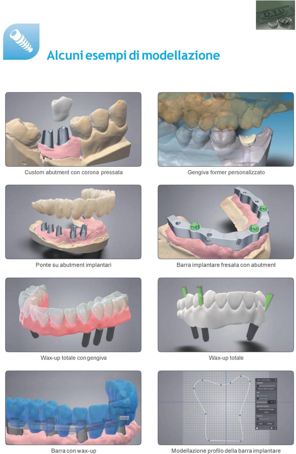 implantare fresata con abutment Wax-up totale con gengiva Wax-up