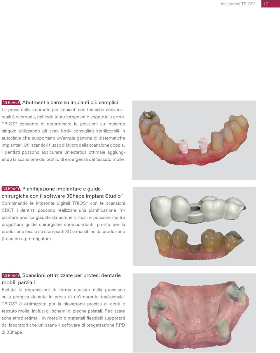 Utilizzando il flusso di lavoro della scansione doppia, i dentisti possono assicurare un estetica ottimale aggiungendo la scansione del profilo di emergenza del tessuto molle.