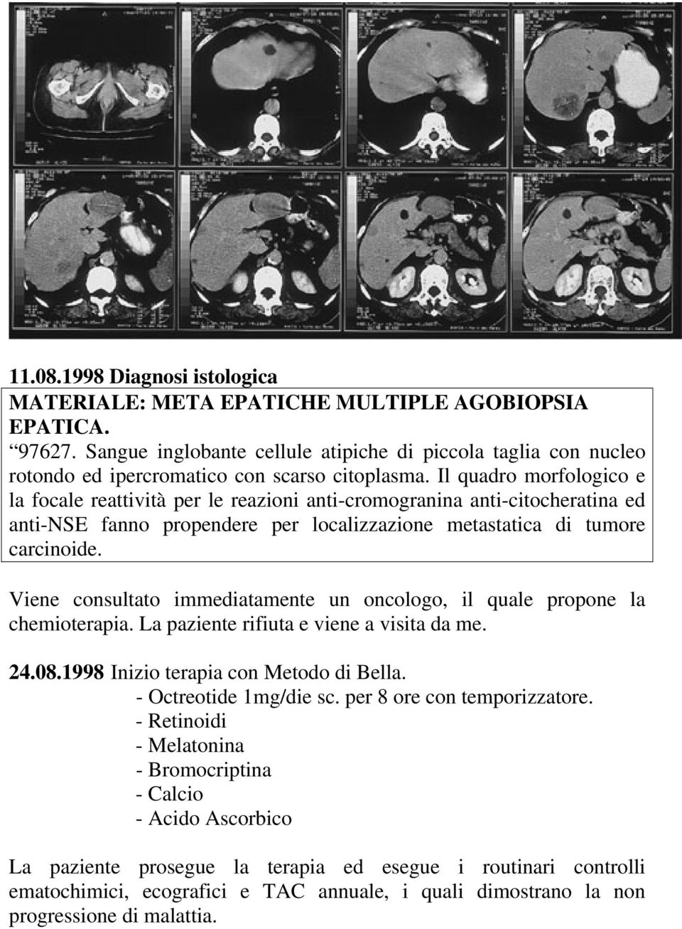 Il quadro morfologico e la focale reattività per le reazioni anti-cromogranina anti-citocheratina ed anti-nse fanno propendere per localizzazione metastatica di tumore carcinoide.