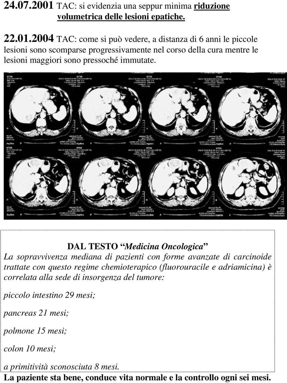 2004 TAC: come si può vedere, a distanza di 6 anni le piccole lesioni sono scomparse progressivamente nel corso della cura mentre le lesioni maggiori sono pressoché