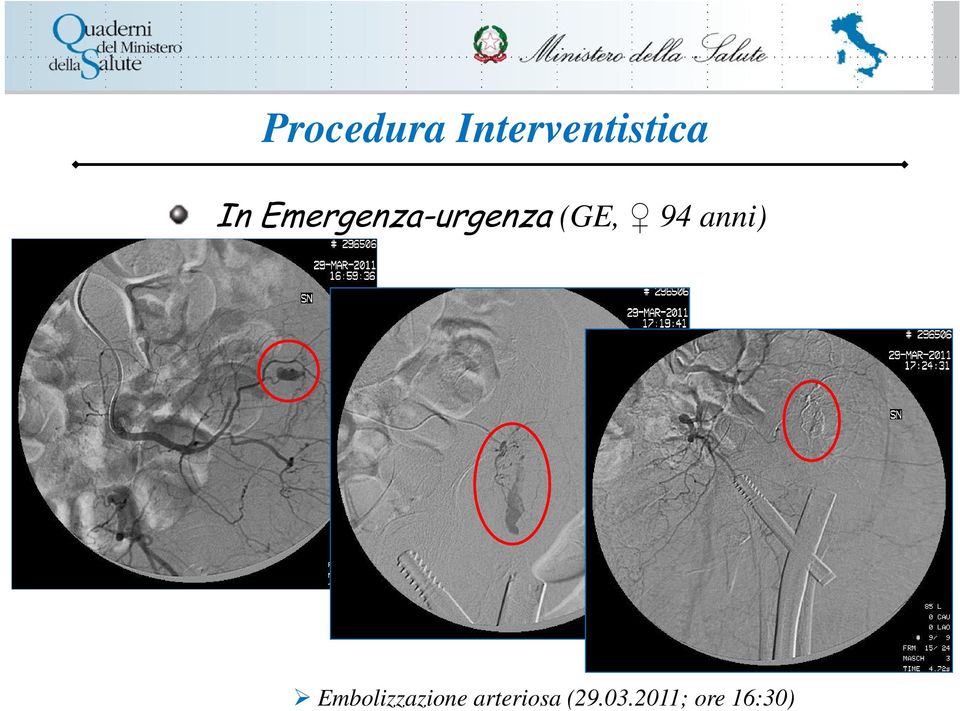 Embolizzazione