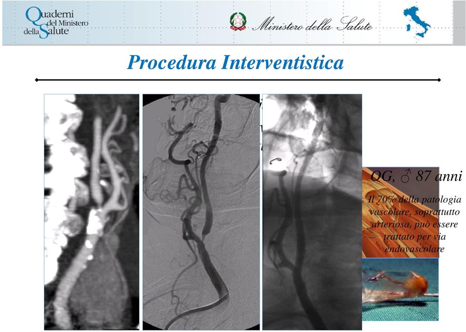 patologia vascolare, soprattutto