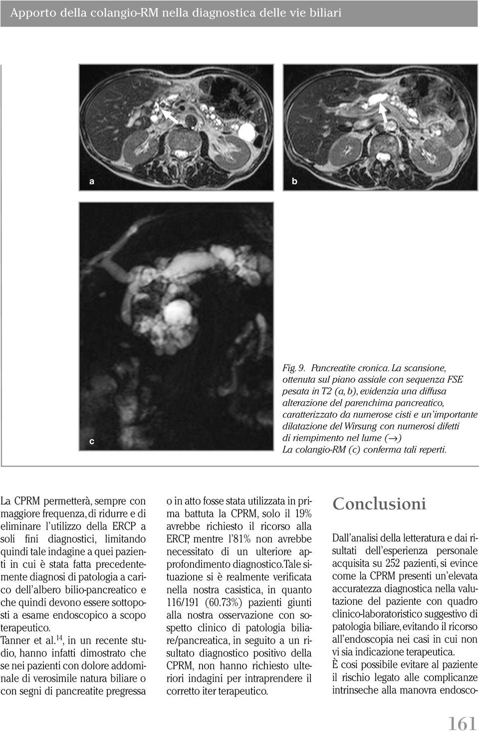 scopo terpeutico. Tnner et l.14, in un recente studio, hnno inftti dimostrto che se nei pzienti con dolore ddominle di verosimile ntur ilire o con segni di pncretite pregress Fig. 9. Pncretite cronic.