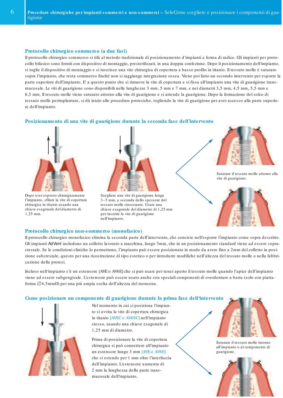 Gli impianti per protocollo bifasico sono forniti con dispositivo di montaggio, presterilizzati, in una doppia confezione.