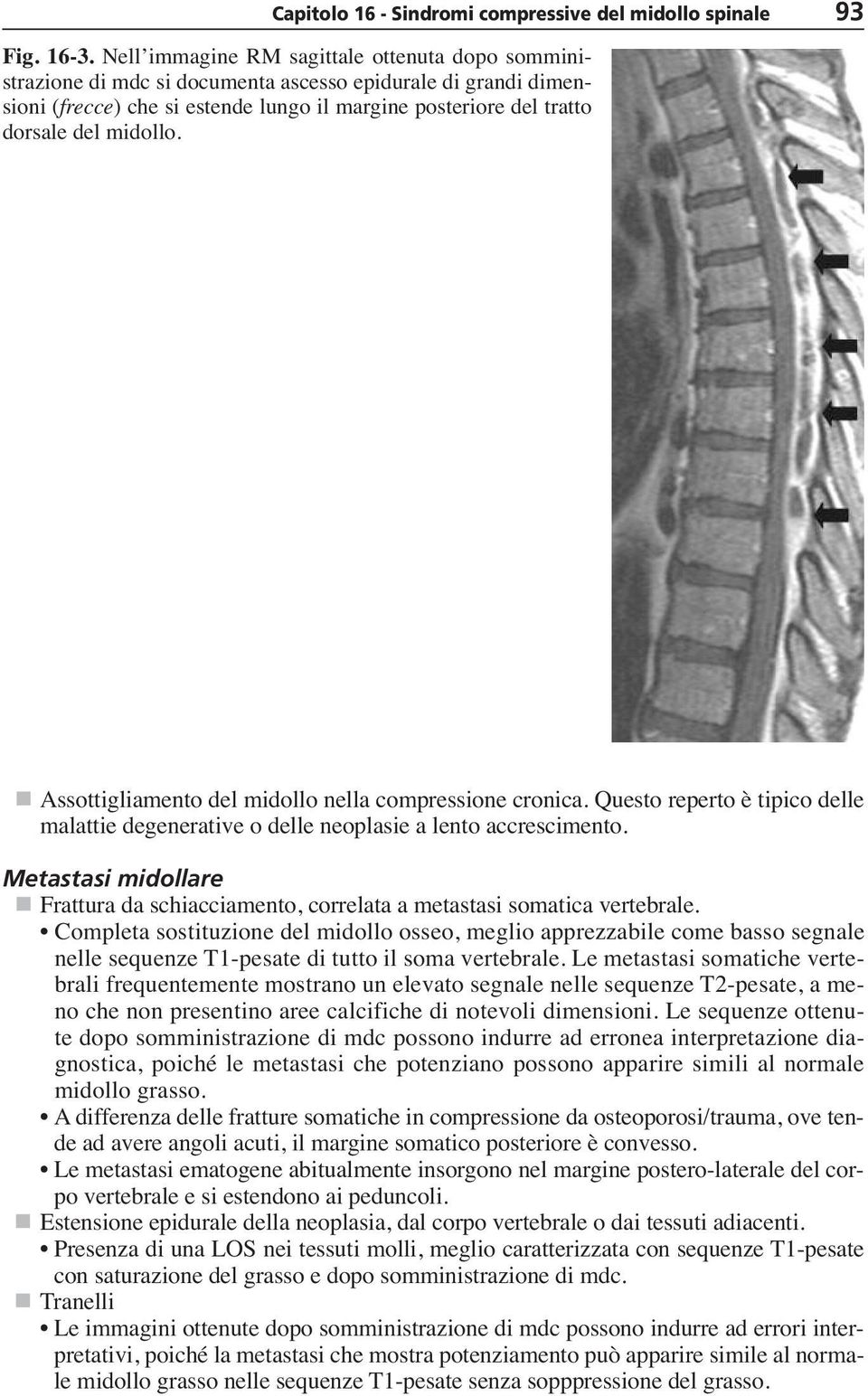 Assottigliamento del midollo nella compressione cronica. Questo reperto è tipico delle malattie degenerative o delle neoplasie a lento accrescimento.