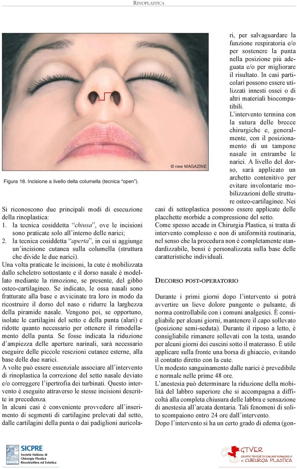 la tecnica cosiddetta aperta, in cui si aggiunge un incisione cutanea sulla columella (struttura che divide le due narici).