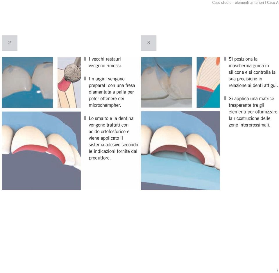 Lo smalto e la dentina vengono trattati con acido ortofosforico e viene applicato il sistema adesivo secondo le indicazioni fornite dal
