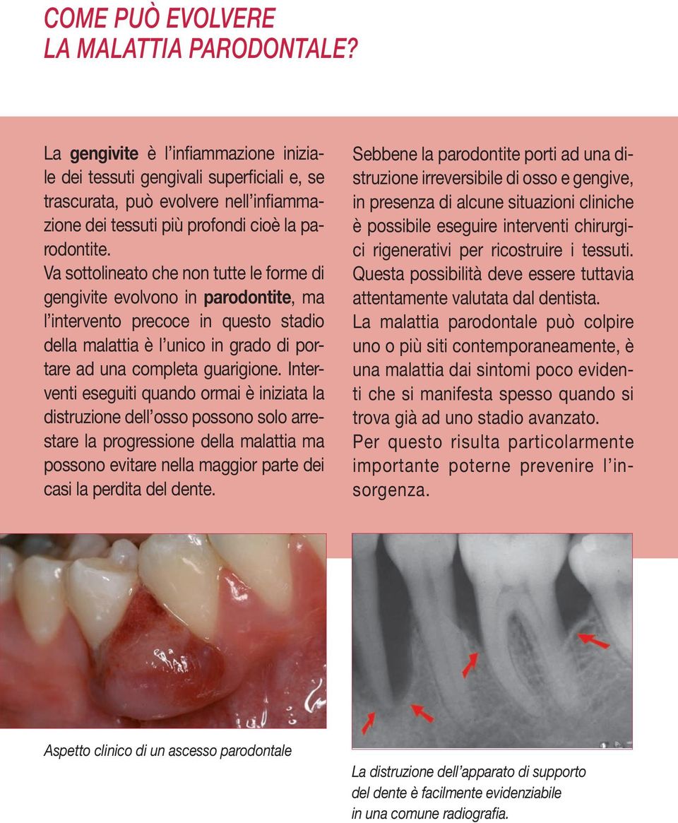 Va sottolineato che non tutte le forme di gengivite evolvono in parodontite, ma l intervento precoce in questo stadio della malattia è l unico in grado di portare ad una completa guarigione.