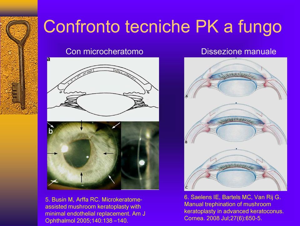 Microkeratomeassisted mushroom keratoplasty with minimal endothelial replacement.