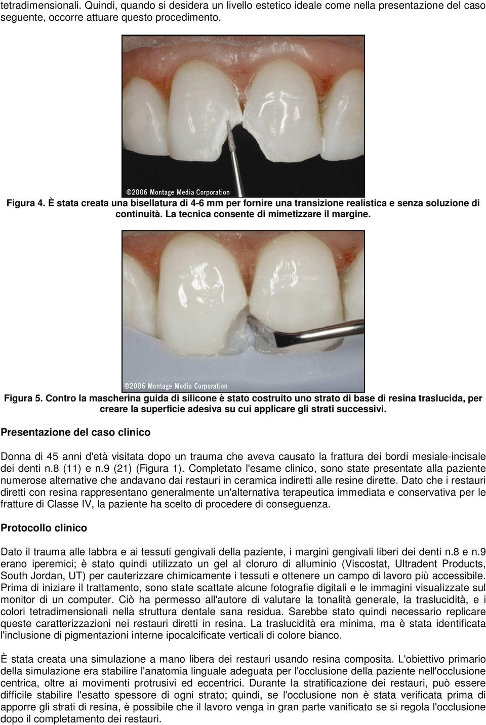 Contro la mascherina guida di silicone è stato costruito uno strato di base di resina traslucida, per creare la superficie adesiva su cui applicare gli strati successivi.