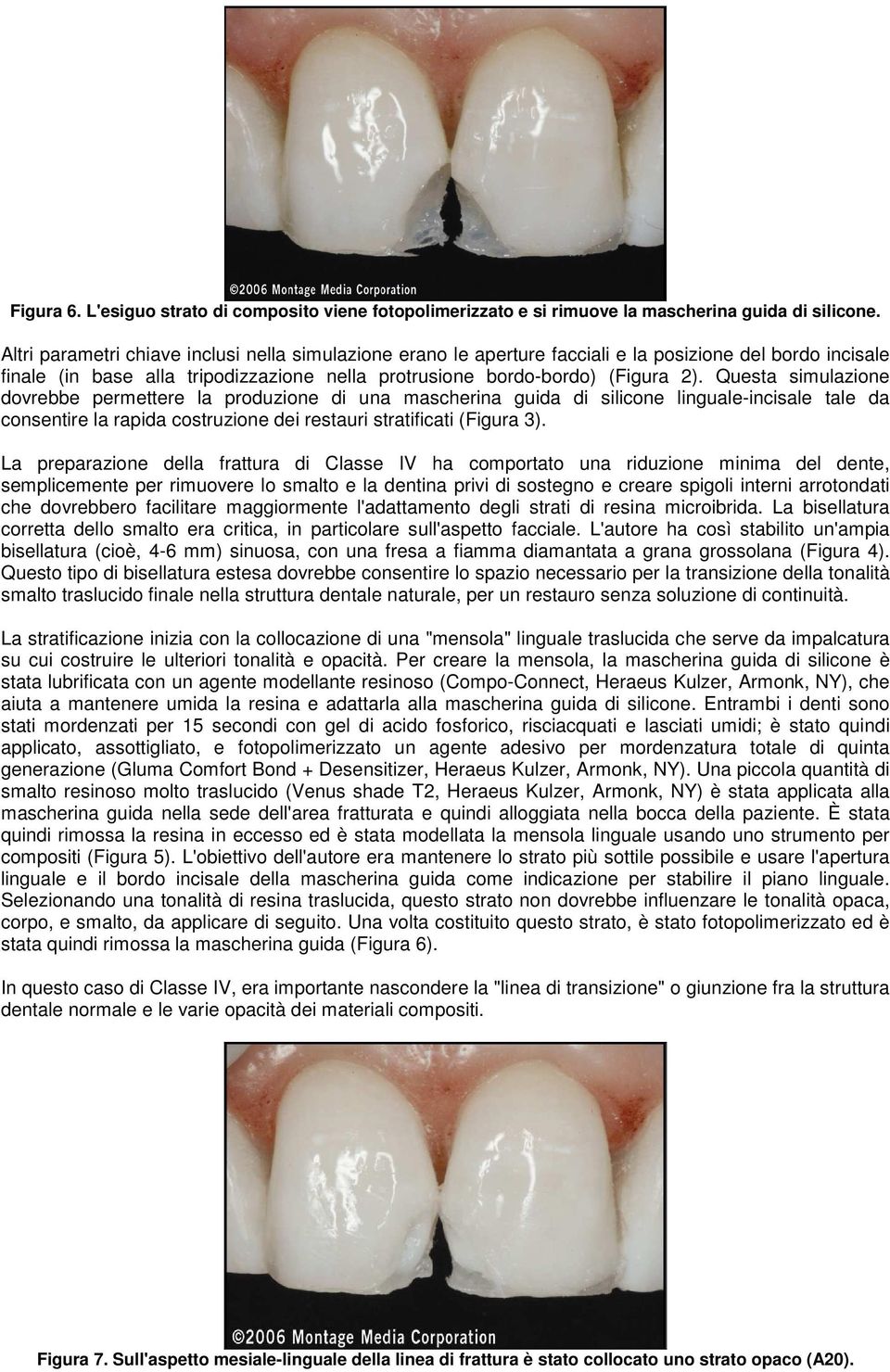 Questa simulazione dovrebbe permettere la produzione di una mascherina guida di silicone linguale-incisale tale da consentire la rapida costruzione dei restauri stratificati (Figura 3).