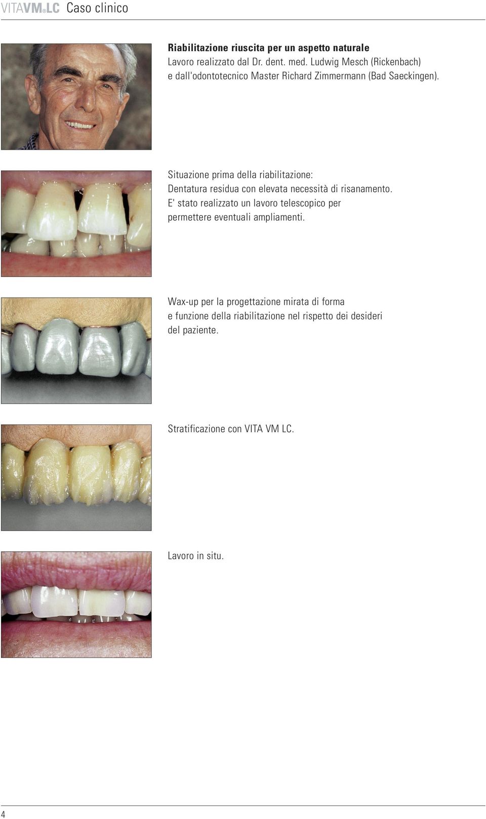 Situazione prima della riabilitazione: Dentatura residua con elevata necessità di risanamento.