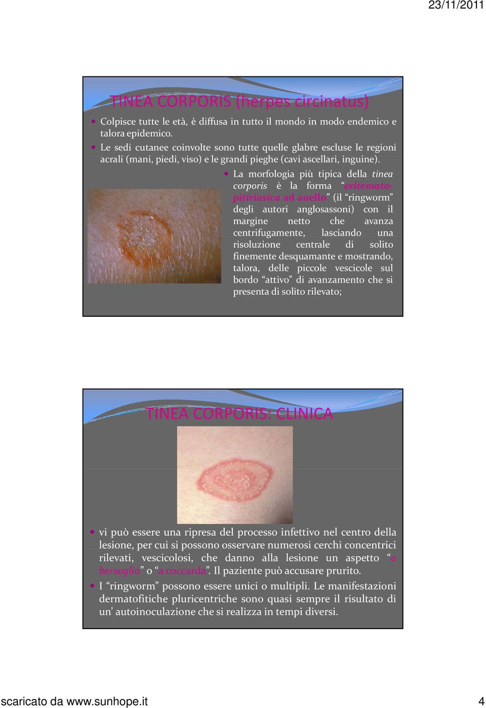 i La morfologia più tipica della tinea corporis è la forma eritematopitiriasica ad anello (il ringworm degli autori anglosassoni) con il margine netto che avanza centrifugamente, lasciando una