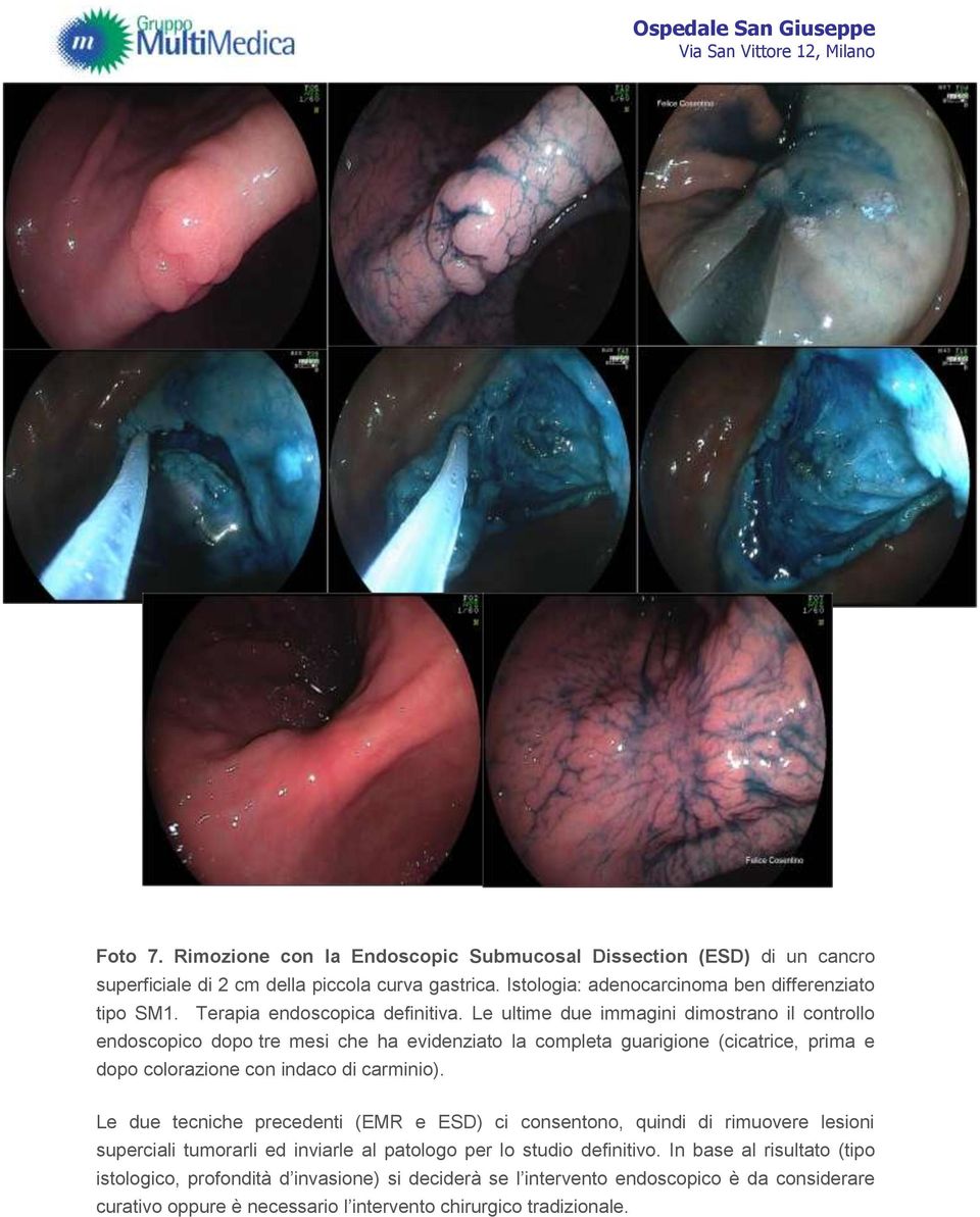 Le ultime due immagini dimostrano il controllo endoscopico dopo tre mesi che ha evidenziato la completa guarigione (cicatrice, prima e dopo colorazione con indaco di carminio).