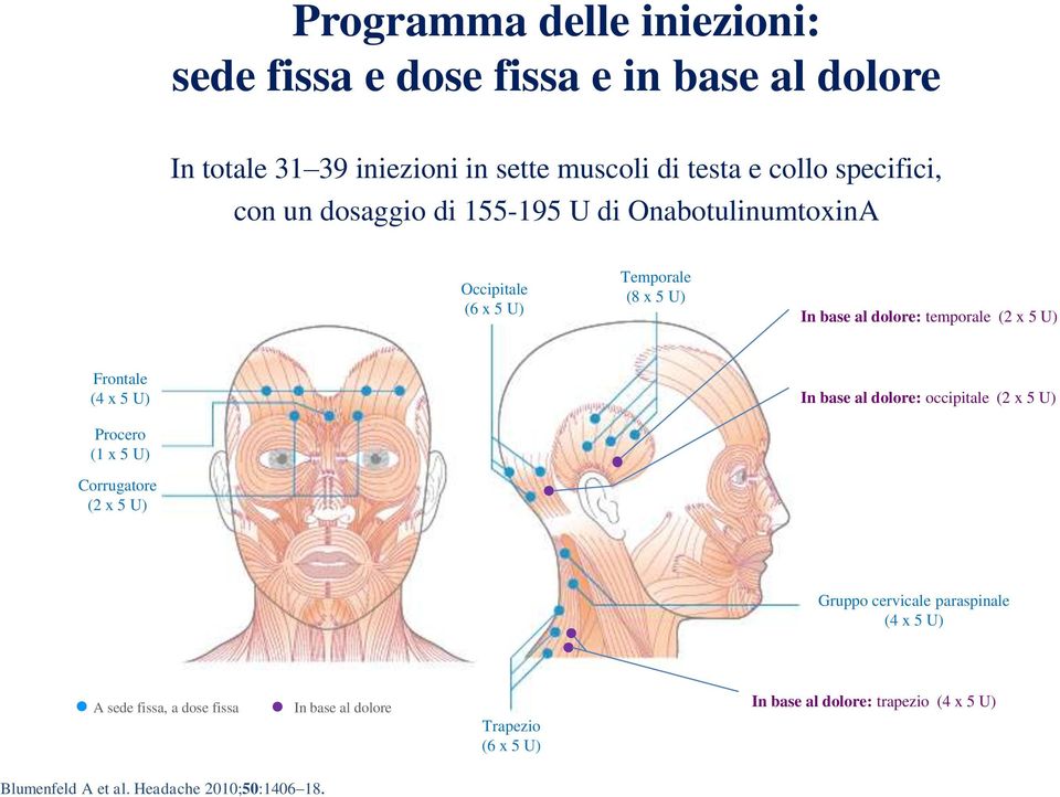 U) Frontale (4 x 5 U) In base al dolore: occipitale (2 x 5 U) Procero (1 x 5 U) Corrugatore (2 x 5 U) Gruppo cervicale paraspinale (4 x 5