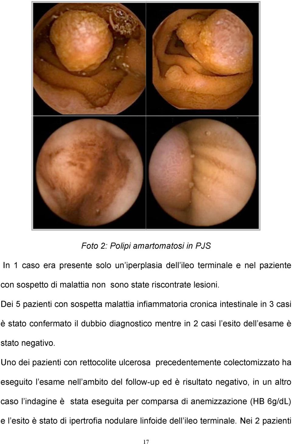 Dei 5 pazienti con sospetta malattia infiammatoria cronica intestinale in 3 casi è stato confermato il dubbio diagnostico mentre in 2 casi l esito dell esame è stato