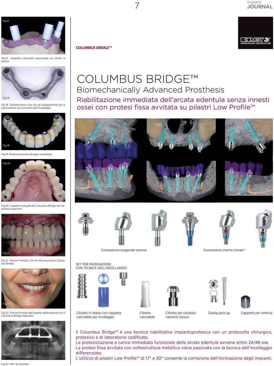 senza innesti ossei con protesi fissa avvitata su pilastri Low Profile Fig.19 Fig.19 Protesi Columbus Bridge completata Fig.20 Fig.